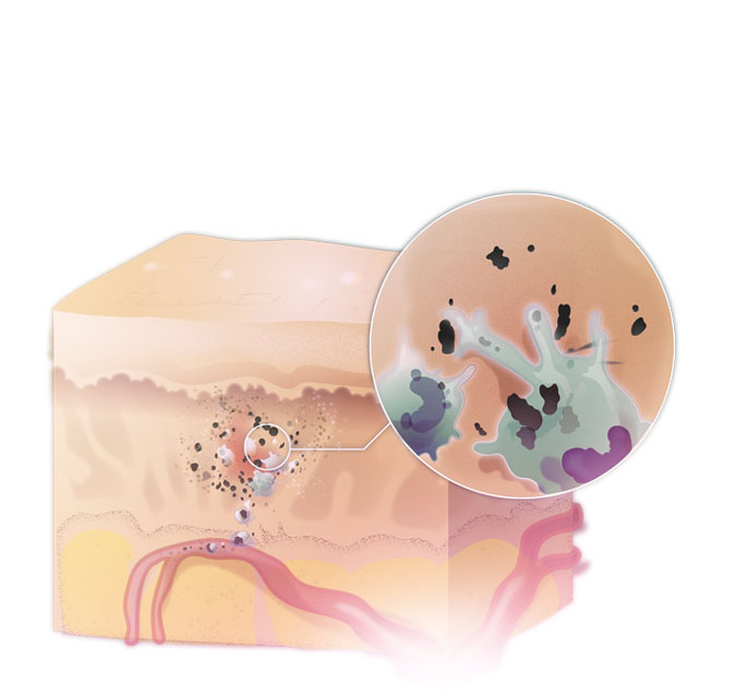 Illustration Immunsystem transportiert Pigmente ab