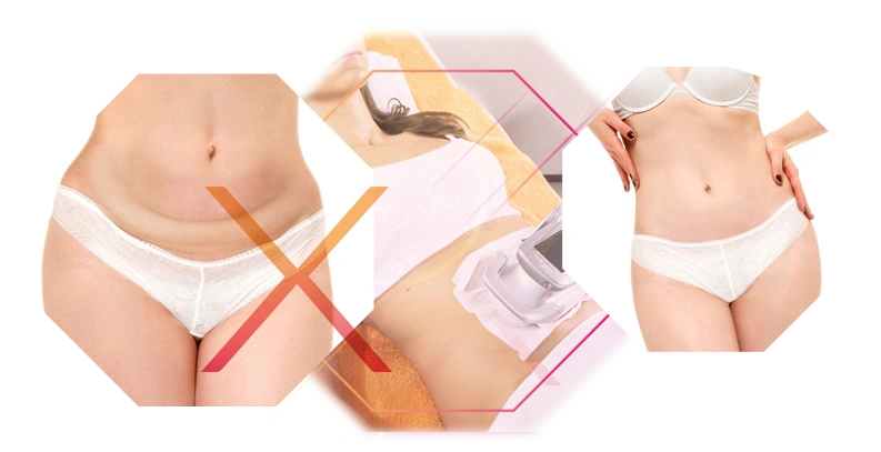Bilder Unterbauch vor und nach der Behandlung